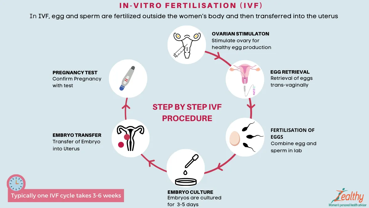 體外受精（IVF）流程示意圖